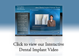 Dental Implant Presentation