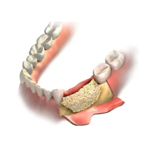 Essential Tips Before Bone Grafting in San Francisco