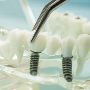 Dental Implants San Francisco showing titanium implant posts supporting natural-looking replacement teeth