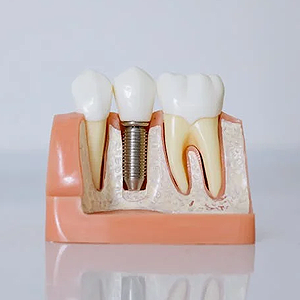 immediate-dental-implants-benefits-and-more-san-francisco