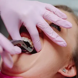 Wisdom Teeth Removal in San Francisco: Myths and Facts Wisdom Teeth Removal: Myths vs. Facts