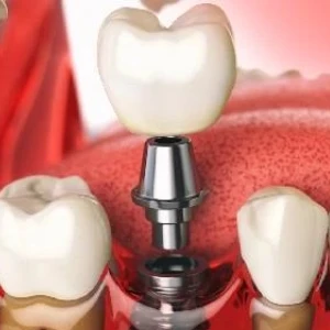 Emerging Technologies for Dental Implants in San Francisco