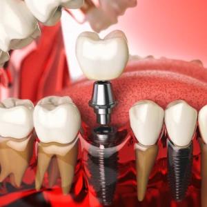 Illustration of dental implants in San Francisco showing implant-supported tooth replacement