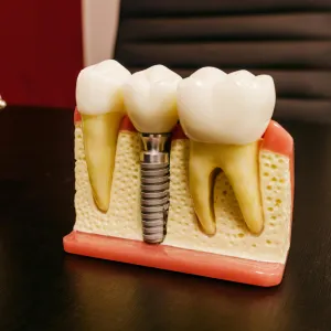 Top Mistakes to Avoid with Dental Implants in San Francisco