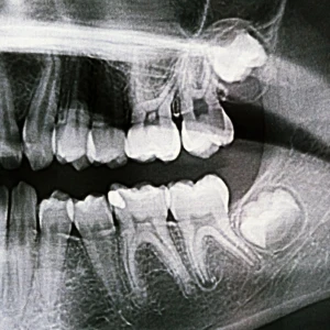 Wisdom teeth in San Francisco X-ray showing impacted upper and lower wisdom teeth